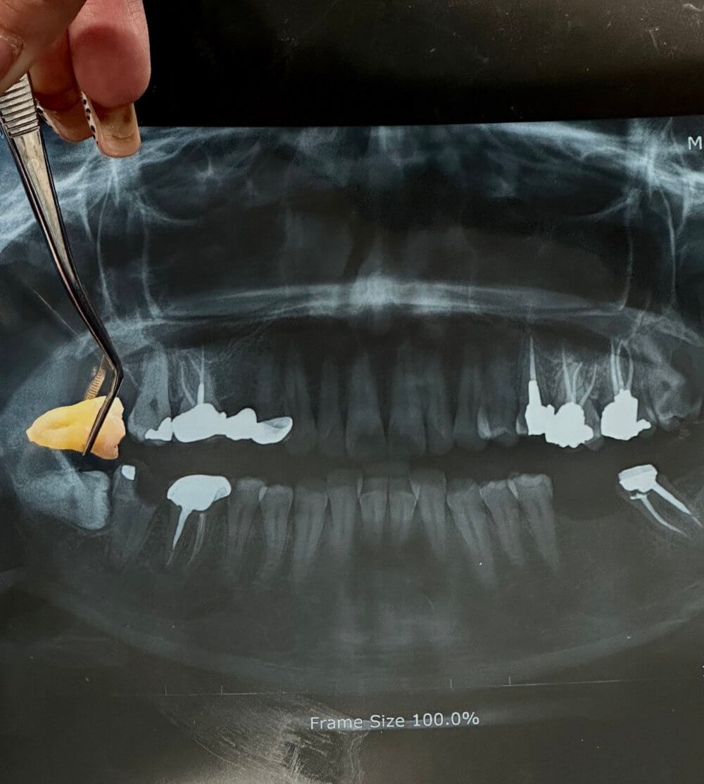 Tooth-Extraction-02
